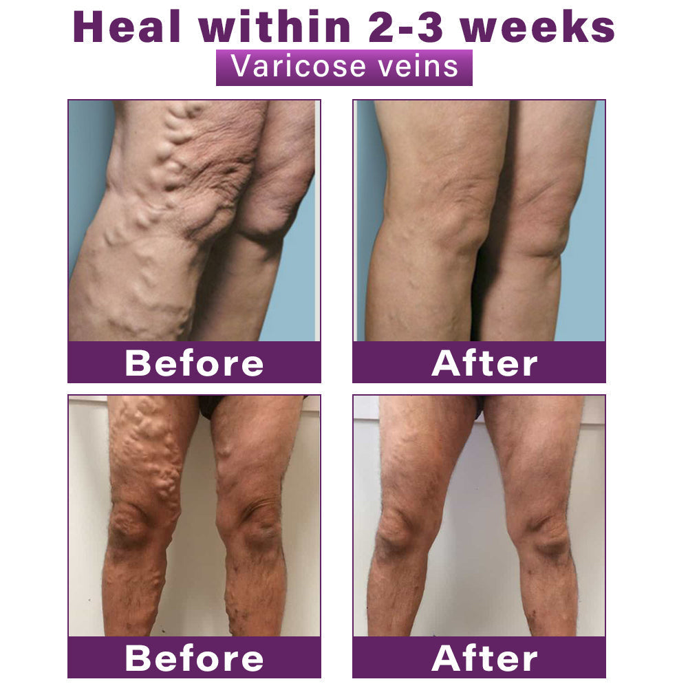 ✅Seurico™ Polidocanol Nano Varicose Vein Patch Recommended by the Society for Vascular Surgery