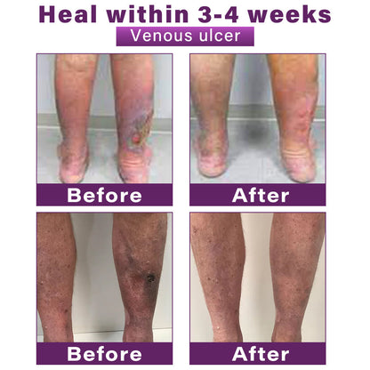 ✅Seurico™ Polidocanol Nano Varicose Vein Patch Recommended by the Society for Vascular Surgery