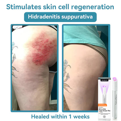 Seurico™ VelvetSkin+ All-in-One Laser Eraser Pen✨ | Safe & Easy At-Home Solution for Smooth, Spot-Free Skin 💆‍♀️🌟