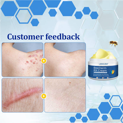👩‍⚕️LBMLBM™ BeeDerm RX Cream, Painless, easy and gentle fix for warts, skin tags, lumps, infections, cysts and scars