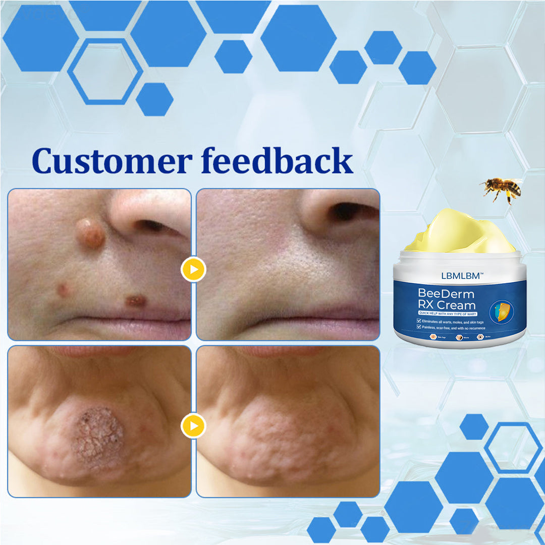 👩‍⚕️LBMLBM™ BeeDerm RX Cream, Painless, easy and gentle fix for warts, skin tags, lumps, infections, cysts and scars