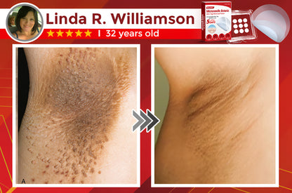 Negusy™ MicroNeedle Botanic Skin Tag Removal Patches – 🇺🇸 Made in the USA | Fast, Painless, Plant-Powered