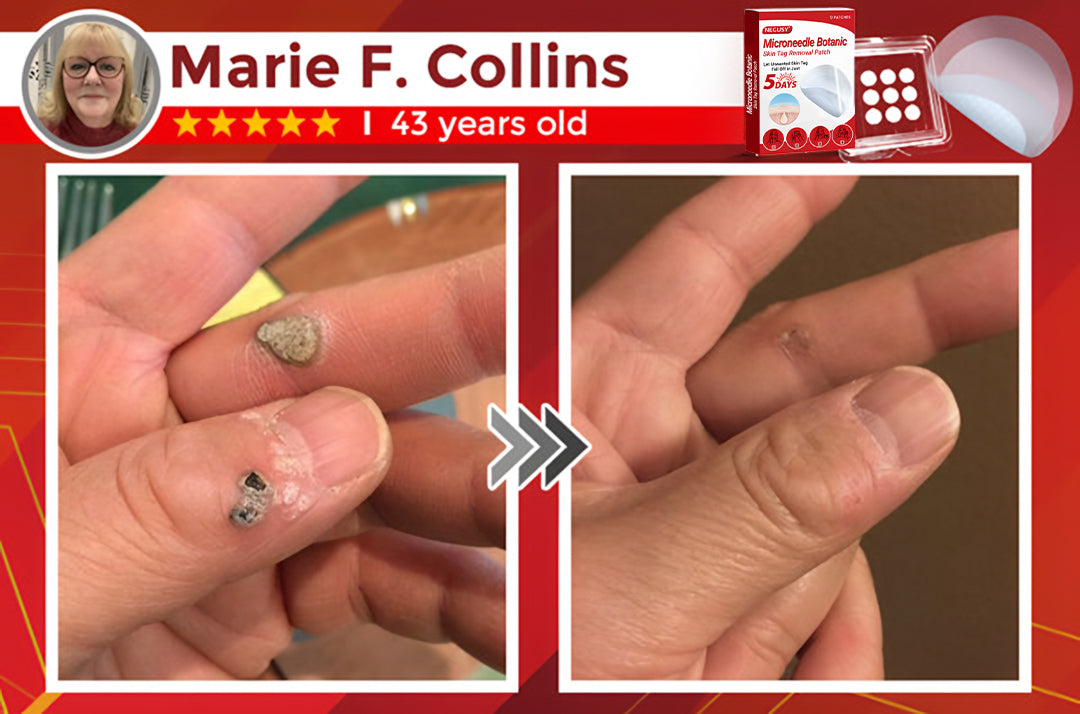 Negusy™ MicroNeedle Botanic Skin Tag Removal Patches – 🇺🇸 Made in the USA | Fast, Painless, Plant-Powered