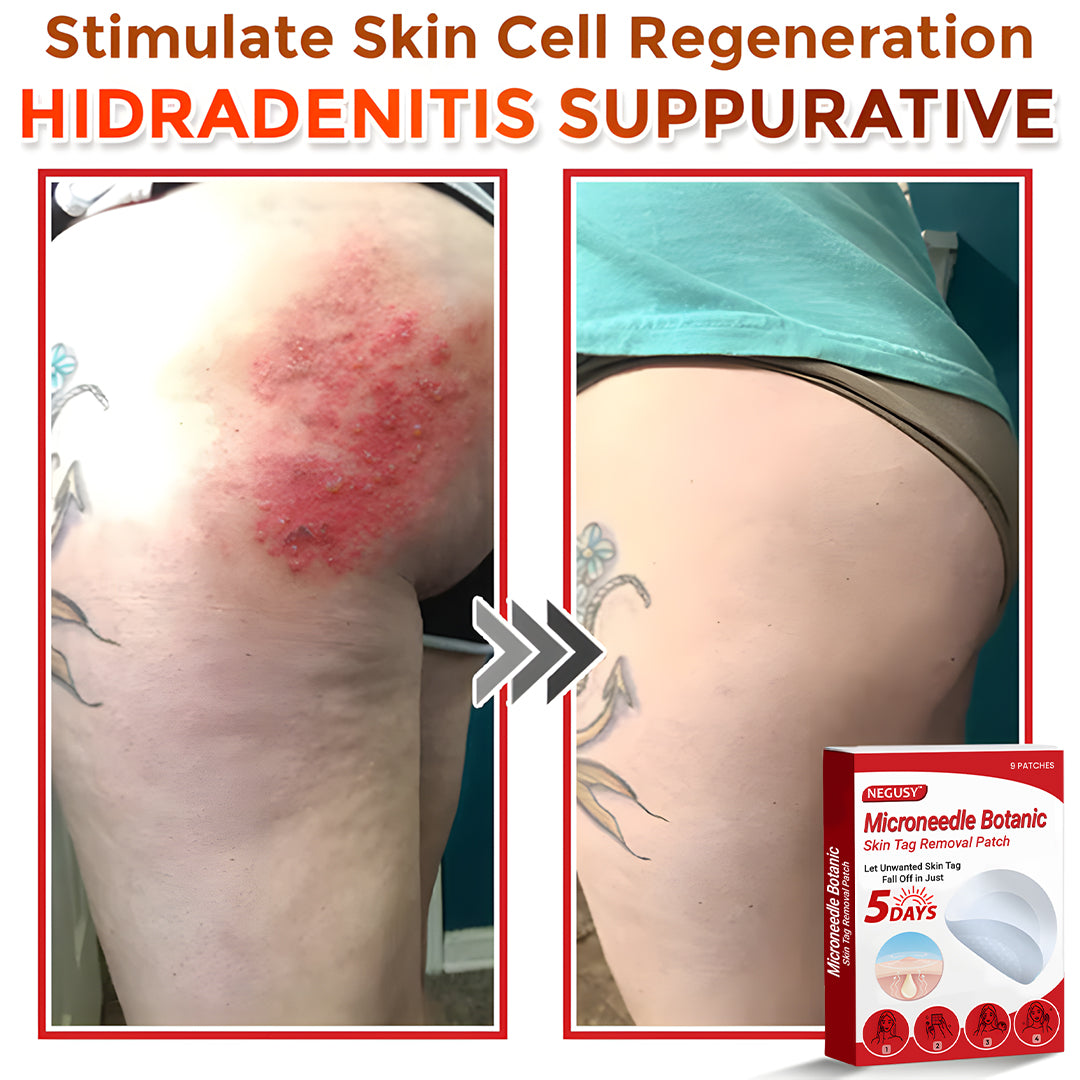 Negusy™ MicroNeedle Botanic Skin Tag Removal Patches – 🇺🇸 Made in the USA | Fast, Painless, Plant-Powered