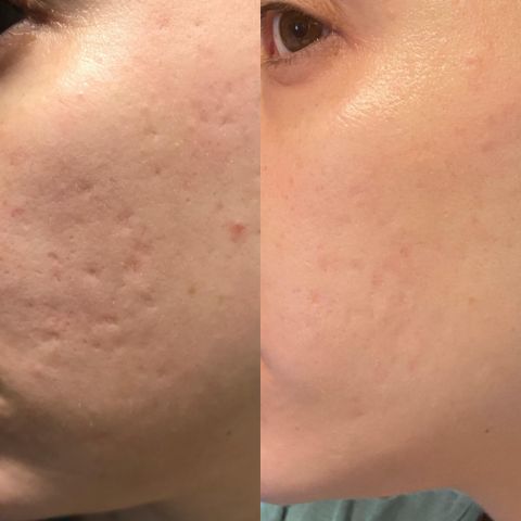 Seurico™ -Silicone Scar Care Sheets🔥