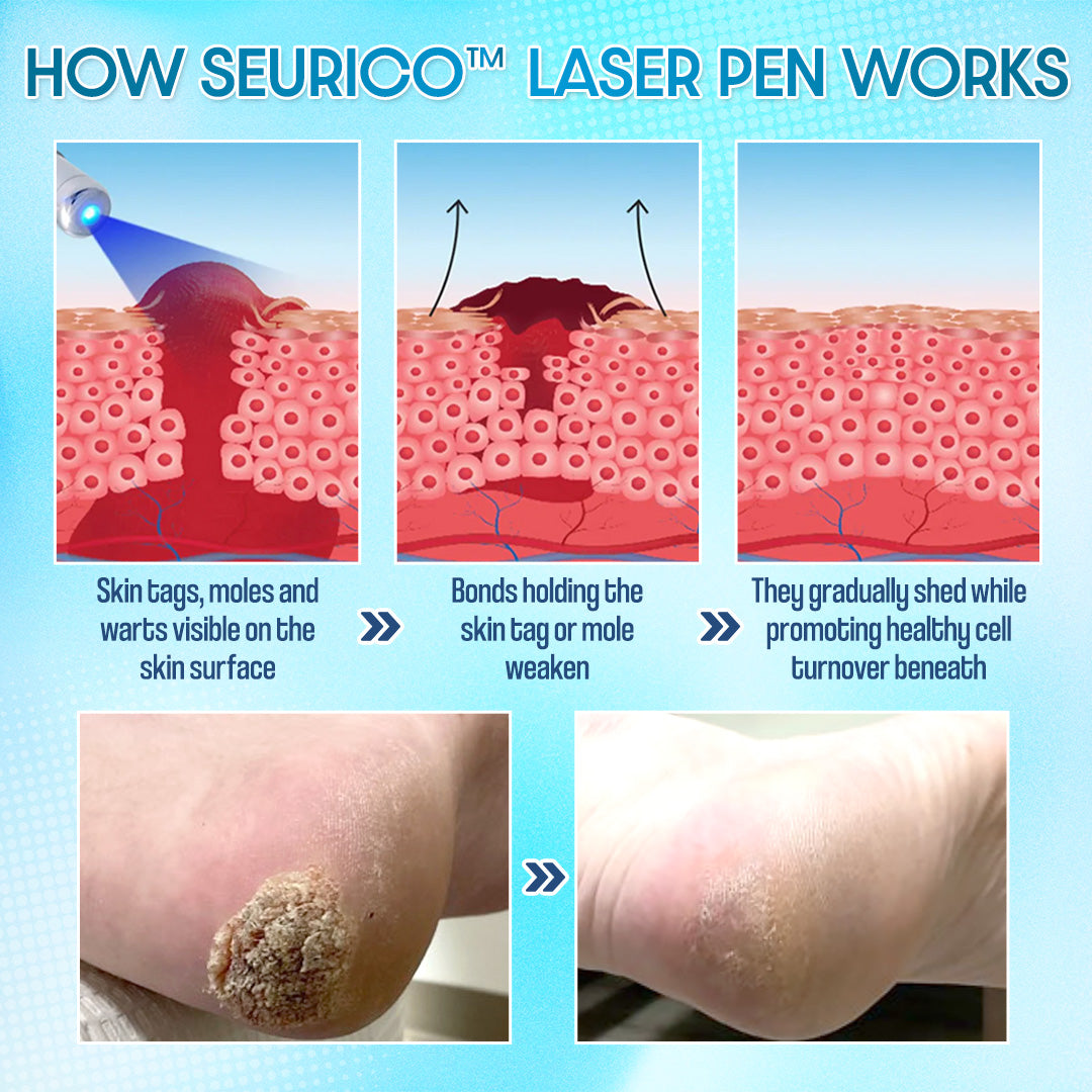 ✨Seurico™ Laser Pen - Non-invasive Mole and Wart Removal
