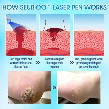 ✨Seurico™ Laser Pen - Non-invasive Mole and Wart Removal