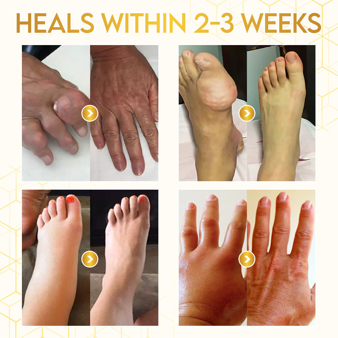 🎁Flash Sale - ODALIT™ Botulinum Toxin & Bee Venom Pain-Relief Bone Healing Cream