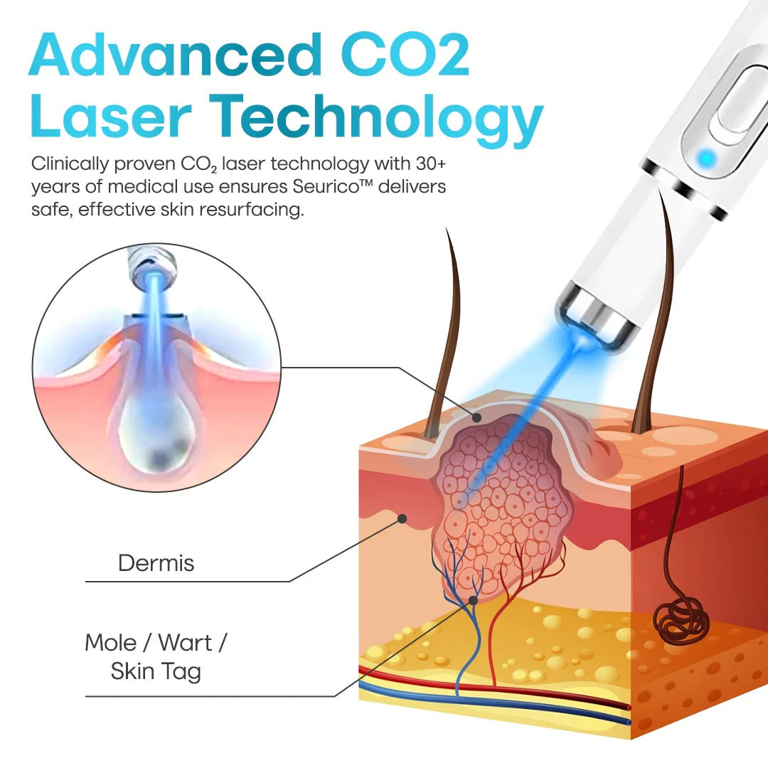 ✨Seurico™ Laser Pen - Non-invasive Mole and Wart Removal